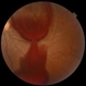 After YAG Laser Treatment