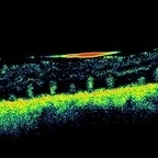 Retinal Folds Following Retinal Reattachment Surgery - Retina Image Bank