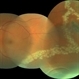 Laser Barrage for Temporal Localized Rhematogenous Retinal Detachment Laser Barrage for Temporal Localized Rhematogenous Retinal Detachment