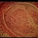 Neurofibroma Pathology Slide Neurofibroma Pathology Slide