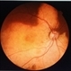 Choroidal osteoma