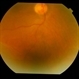 Bilateral Senile Retinoschisis