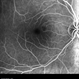 Fundus Fluorescein Angiography of Paracentral Acute Middle Maculopathy Fundus Fluorescein Angiography of Paracentral Acute Middle Maculopathy