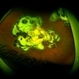Choroidal Osteoma After PDT