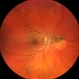 Choroidal nevus with halo Choroidal nevus with halo