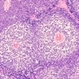 Retinoblastoma