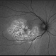 Serpiginous Choroidal Atrophy Serpiginous Choroidal Atrophy