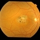 Perifoveal Telangiectasia With CNVM