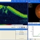 OCT Through Foveal Area in Macular Infarction Secondary to Subconjunctival Gentamicin Injection OCT Through Foveal Area in Macular Infarction Secondary to Subconjunctival Gentamicin Injection