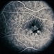 Adult Foveomacular Dystrophy / Pattern Adult Foveomacular Dystrophy / Pattern