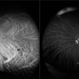 Posterior Uveitis