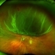 Retinal Detachment Retinal Detachment