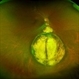 Pseudo-doubling of optic nerve with Coloboma