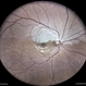 Hemi Central Retinal Artery Occlusion Hemi Central Retinal Artery Occlusion