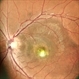 Best Vitelliform  Macular Dystrophy