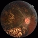 Pigmented Paravenous Retinochoroidal Atrophy Pigmented Paravenous Retinochoroidal Atrophy
