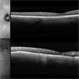 Lipemia Retinalis OCT Lipemia Retinalis OCT