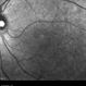 Retinal Dystrophy of 24-Year-Old Male/ IR OS Retinal Dystrophy of 24-Year-Old Male/ IR OS