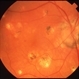 Tularemia Chorioretinitis Tularemia Chorioretinitis
