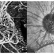 OCTA View of Florid Neovascularization and Enface View OCTA View of Florid Neovascularization and Enface View