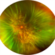 Total Rhegmatogenous Retinal Detachment With Horseshoe Tear and PVR