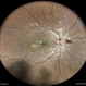 PROLIFERATIVE DIABETIC RETINOPATHY PROLIFERATIVE DIABETIC RETINOPATHY
