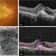 Imaging Feeder Vessels on OCT-A in a case of Retinal Angiomatous Proliferation