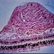Tuberous Sclerosis Tuberous Sclerosis