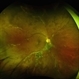 Pigmented Paravenous Retinochoroidal Atrophy Pigmented Paravenous Retinochoroidal Atrophy
