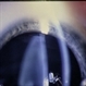 Marfan's  Syndrome Ocular Manifestation Marfan's  Syndrome Ocular Manifestation