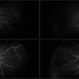 Retinal Ischemia Secondary to Diabetic Retinopathy Retinal Ischemia Secondary to Diabetic Retinopathy