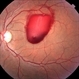 Valsalva Retinopathy