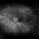 Branch Retinal Vein Occlusion With Peripheral Pigmentary Change Branch Retinal Vein Occlusion With Peripheral Pigmentary Change