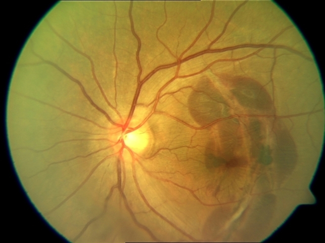 Choiroidal Rupture How Is Choroidal Rupture Diagnosed? – JZQUW