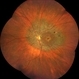 Tapetoretinal Degeneration