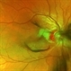 Partial Optic Disc Avulsion with Optic Disc Pit