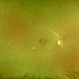 White and Red Spots- Roth Spots and Leukemic Infiltrates in Acute Myeloid Leukemia