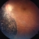 Self-Applied Retinal Detachment Self-Applied Retinal Detachment