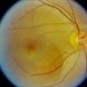 Central Serous Chorioretinopathy (CSR)