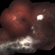 Chorioretinal Scars with Subretinal Fibrosis and an old Retinal Detachment