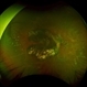 Pigmented Paravenous Retinochoroidal Atrophy Pigmented Paravenous Retinochoroidal Atrophy