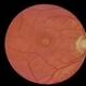 Adult Onset Foveomacular Vitelliform Dystrophy Adult Onset Foveomacular Vitelliform Dystrophy