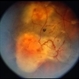 Angioma from Chronic Retinal Detachment Angioma from Chronic Retinal Detachment