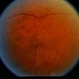 BDR / Macular Edema / Macroaneurysm BDR / Macular Edema / Macroaneurysm