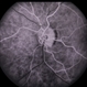 Autosomal Dominant Preretinal Vascular Loops Autosomal Dominant Preretinal Vascular Loops