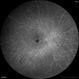 Flourescein Angiography  of Cloroquine Toxicity