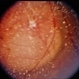 Choroidal Melanoma With Vitreous Seeding Choroidal Melanoma With Vitreous Seeding