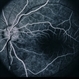 Multiple Sclerosis
