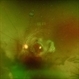 Traumatic Macular Hole Traumatic Macular Hole