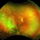 Choroidal Rupture Choroidal Rupture